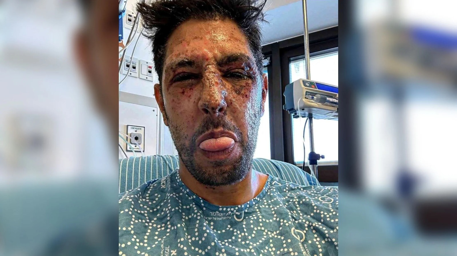 עידן עמדי לאחר הפציעה